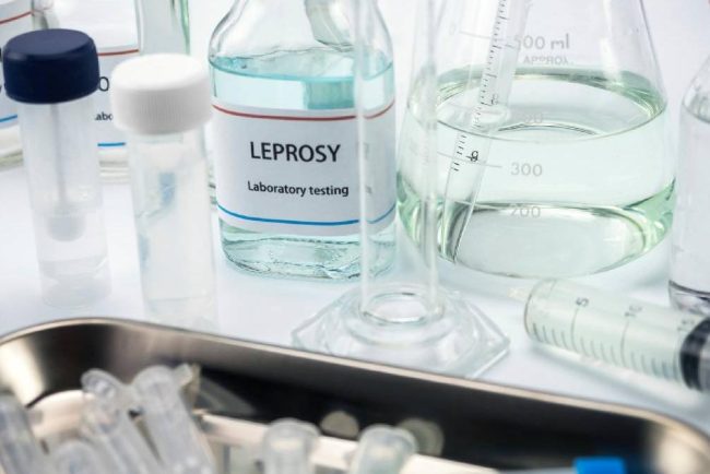 Al doilea caz de lepra confirmat in Cluj Napoca